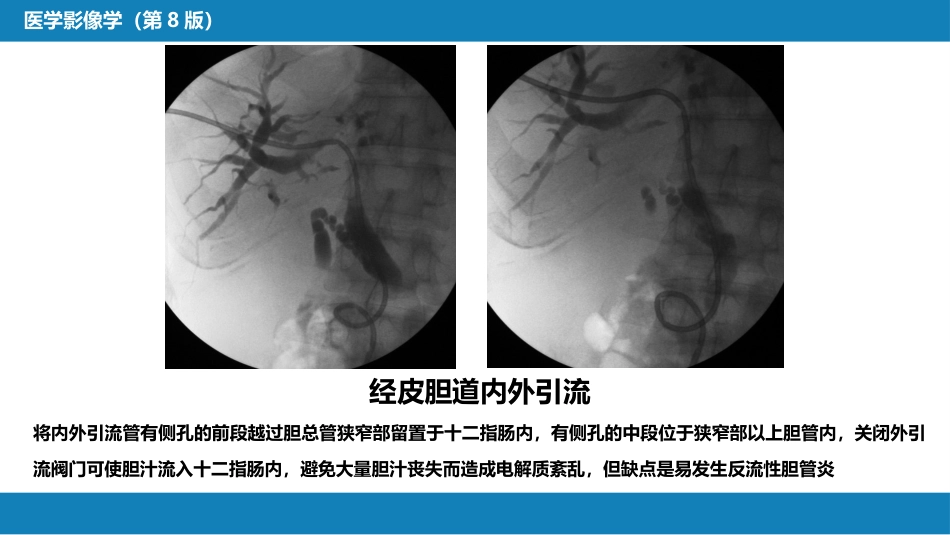 第十四章 非血管疾病介入治疗_第9页