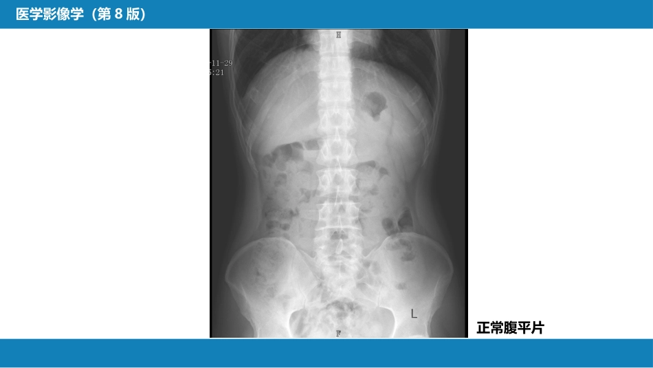 第七章 消化系统与腹膜腔 第四节 急腹症_第12页