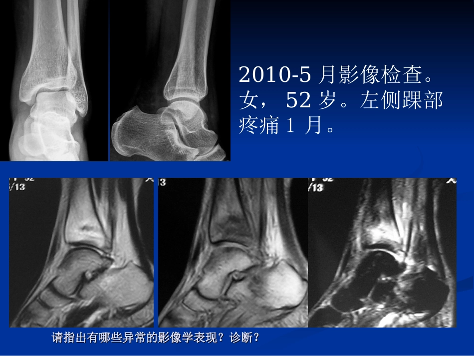 影像学病例读片-应力性骨折_第12页