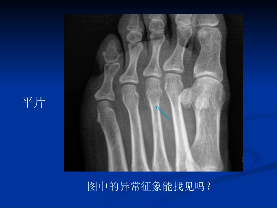 影像学病例读片-应力性骨折_第4页