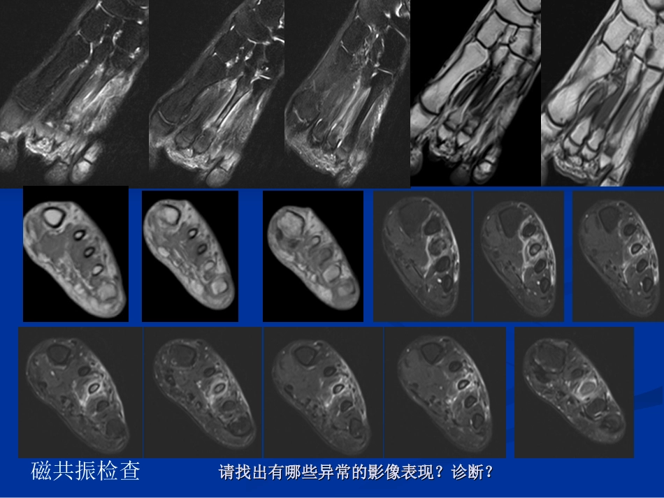 影像学病例读片-应力性骨折_第5页