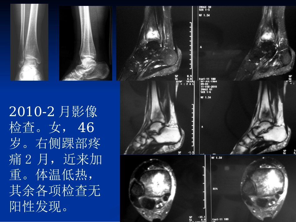 影像学病例读片-应力性骨折_第8页