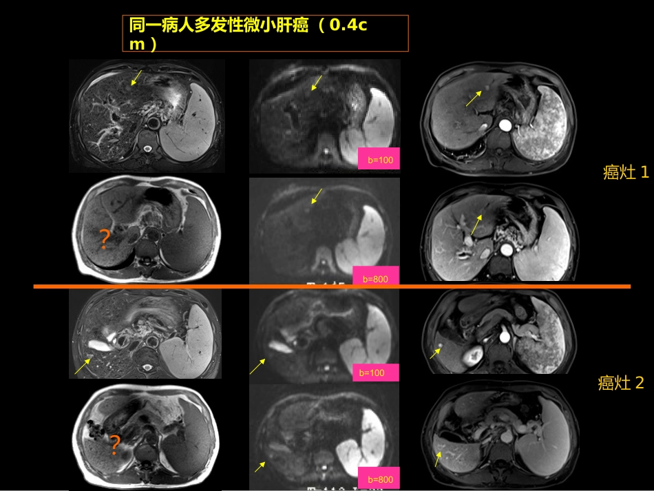 微小肝癌-MR诊断_第12页