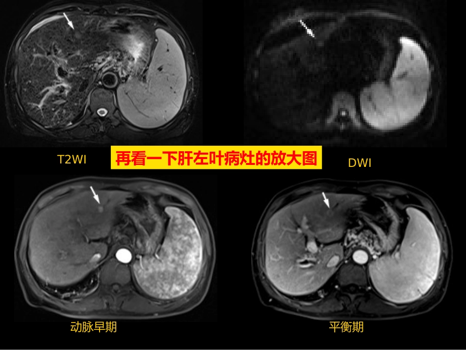 微小肝癌-MR诊断_第13页