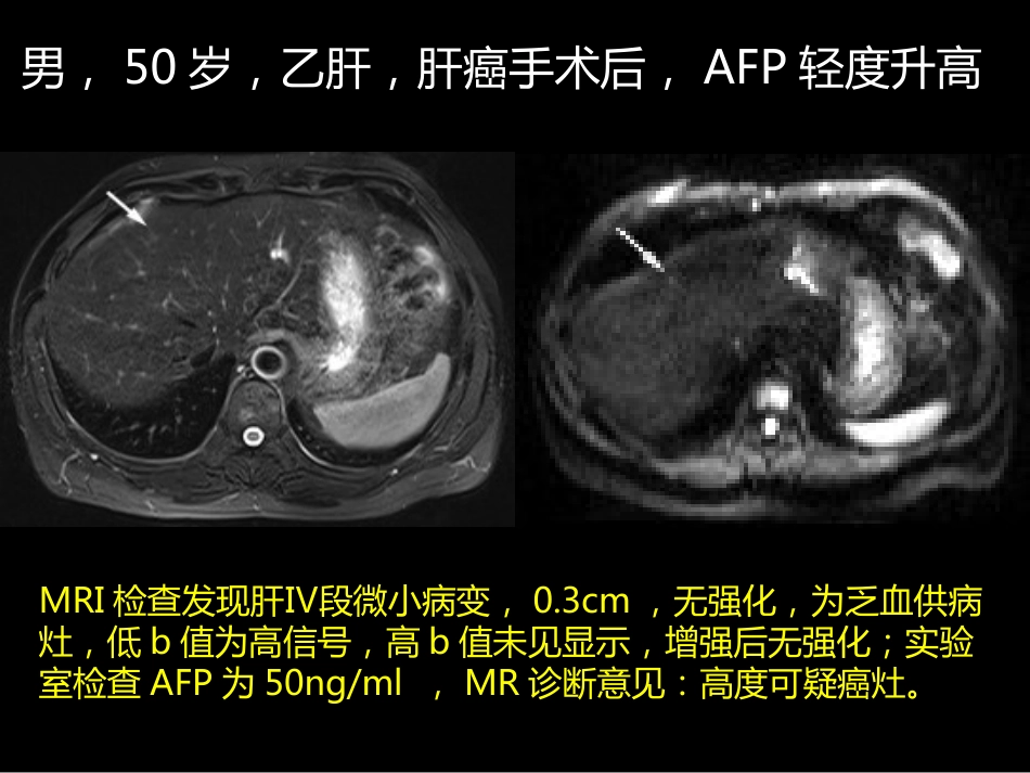 微小肝癌-MR诊断_第15页
