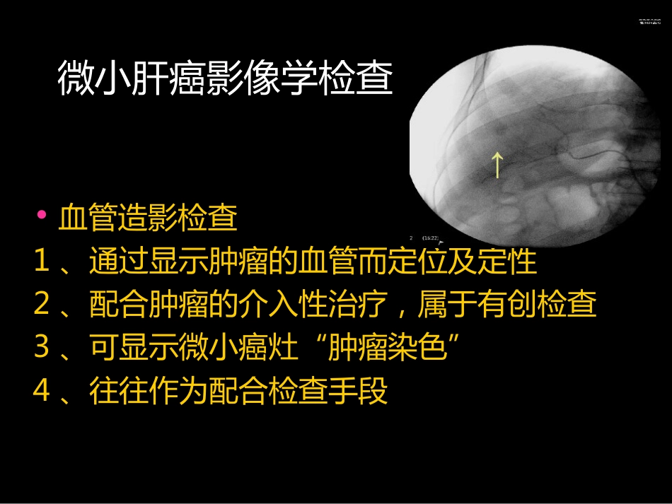 微小肝癌-MR诊断_第8页