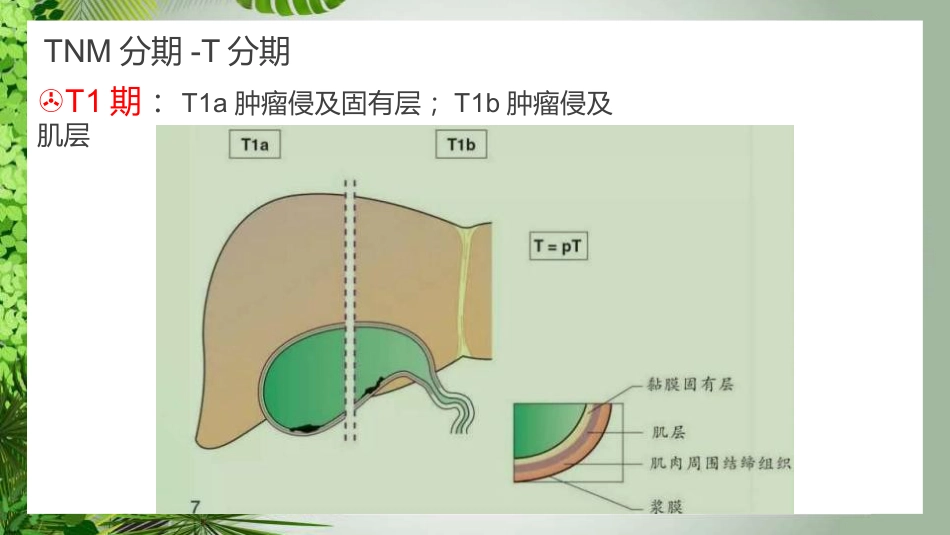 胆囊癌影像_第13页