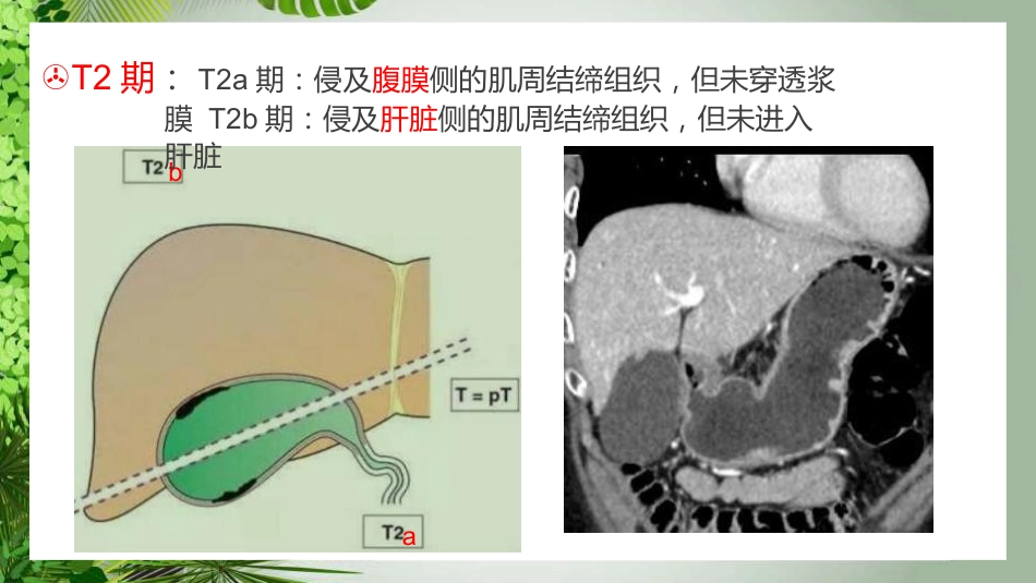 胆囊癌影像_第14页
