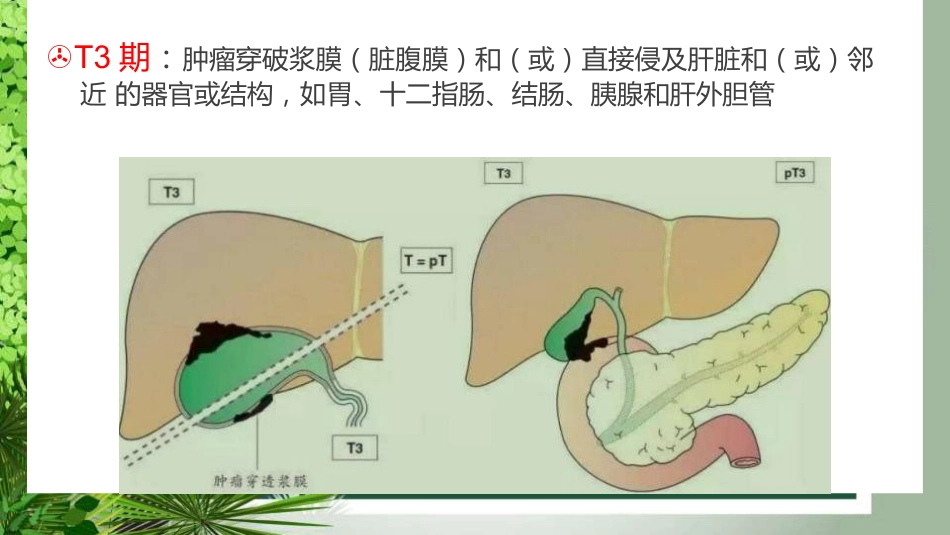 胆囊癌影像_第15页
