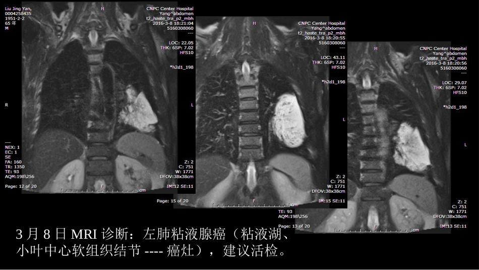 一例肺粘液腺癌综合影像及病理学回顾_第10页