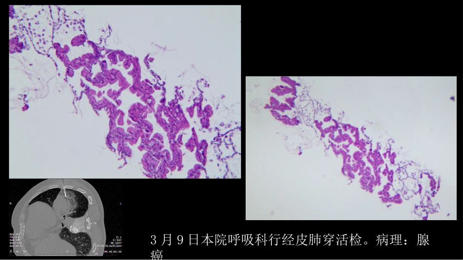 一例肺粘液腺癌综合影像及病理学回顾_第11页
