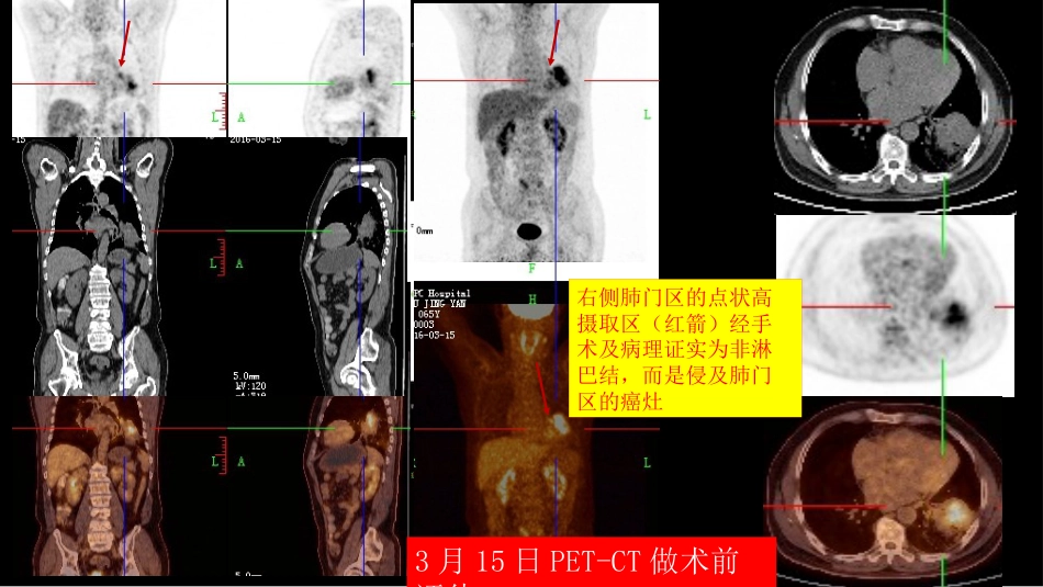 一例肺粘液腺癌综合影像及病理学回顾_第12页