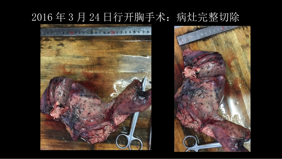 一例肺粘液腺癌综合影像及病理学回顾_第13页