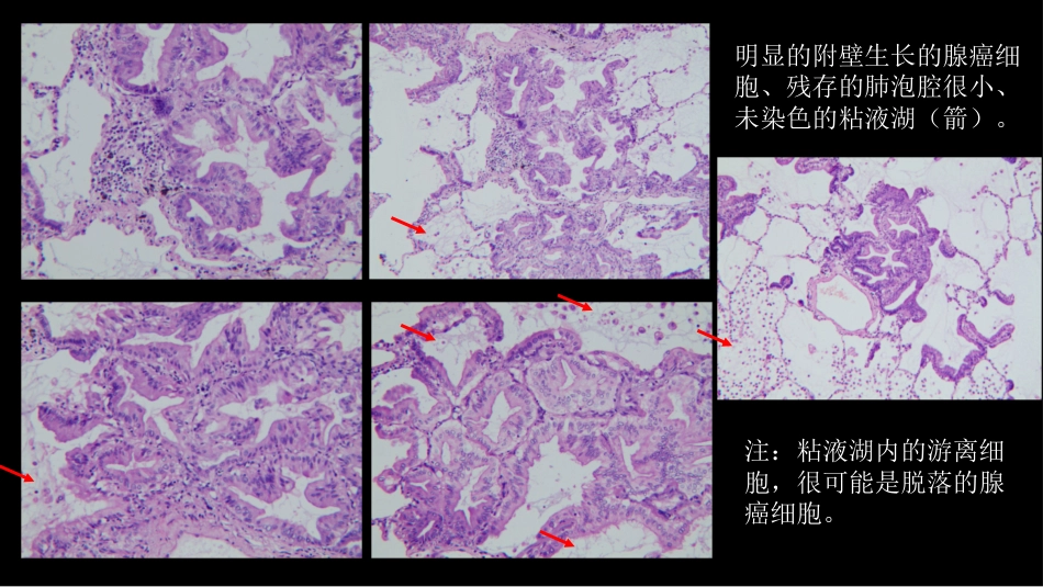 一例肺粘液腺癌综合影像及病理学回顾_第14页