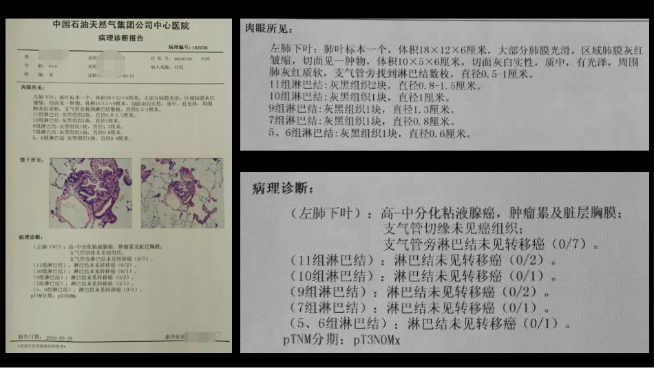 一例肺粘液腺癌综合影像及病理学回顾_第15页