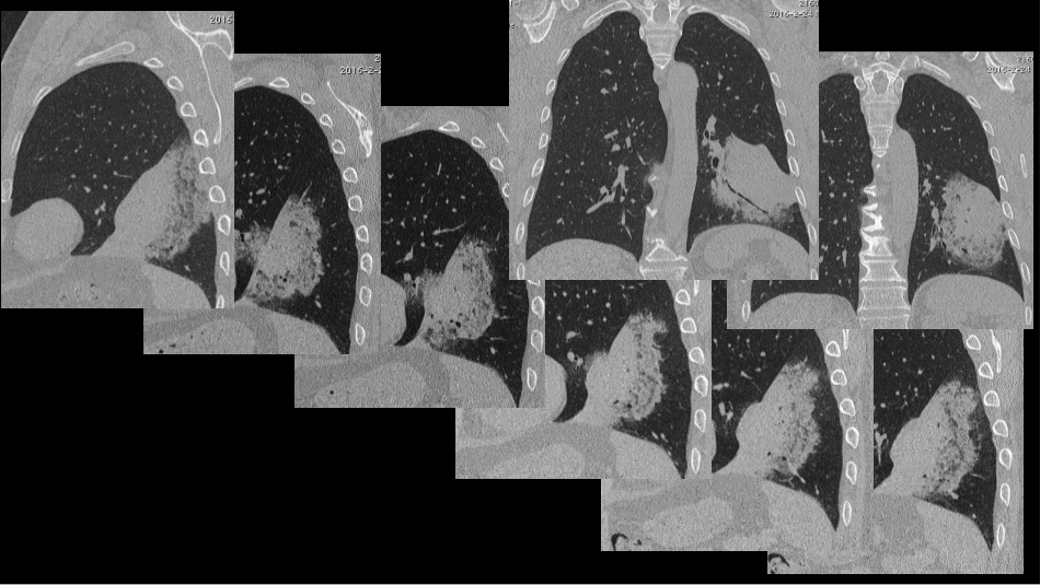 一例肺粘液腺癌综合影像及病理学回顾_第5页