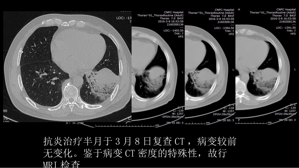 一例肺粘液腺癌综合影像及病理学回顾_第6页