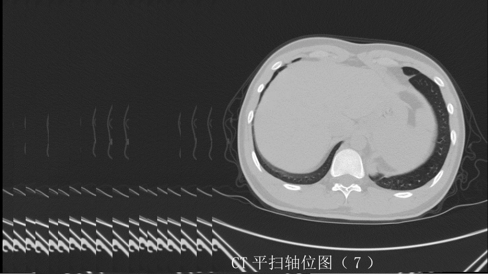 这样的肺隔离症：影像共享_第10页