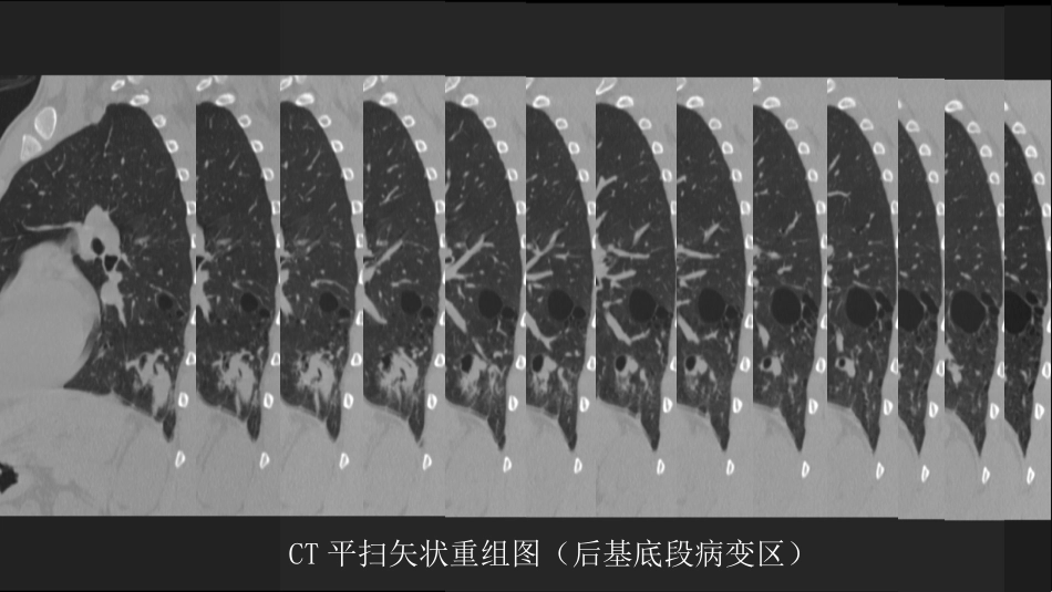 这样的肺隔离症：影像共享_第11页