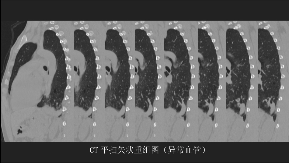 这样的肺隔离症：影像共享_第12页