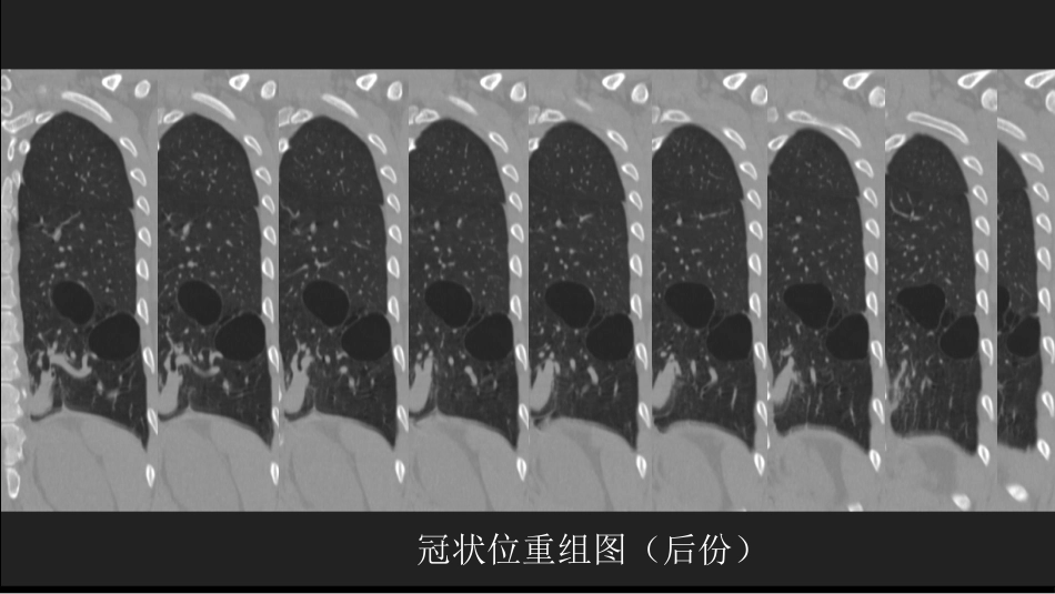 这样的肺隔离症：影像共享_第13页