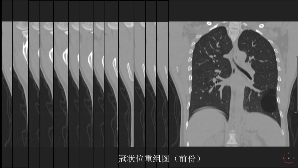 这样的肺隔离症：影像共享_第14页