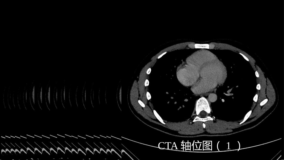 这样的肺隔离症：影像共享_第15页