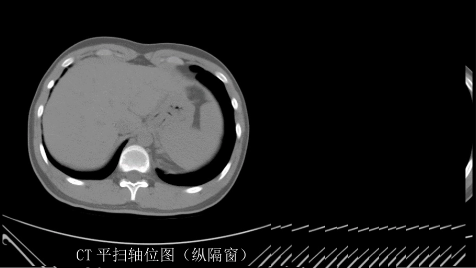 这样的肺隔离症：影像共享_第3页