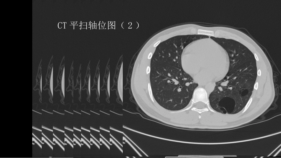 这样的肺隔离症：影像共享_第5页