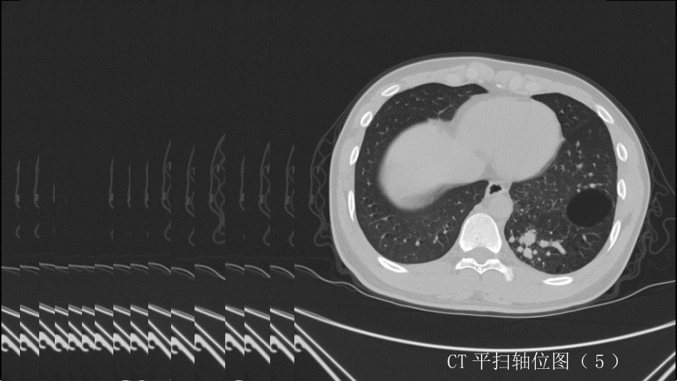 这样的肺隔离症：影像共享_第8页