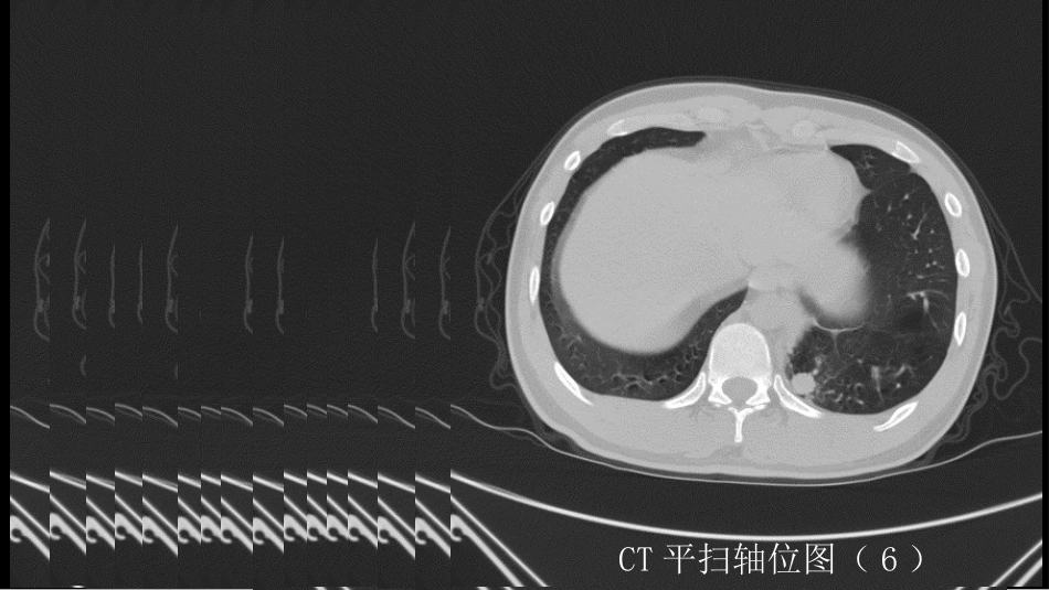 这样的肺隔离症：影像共享_第9页