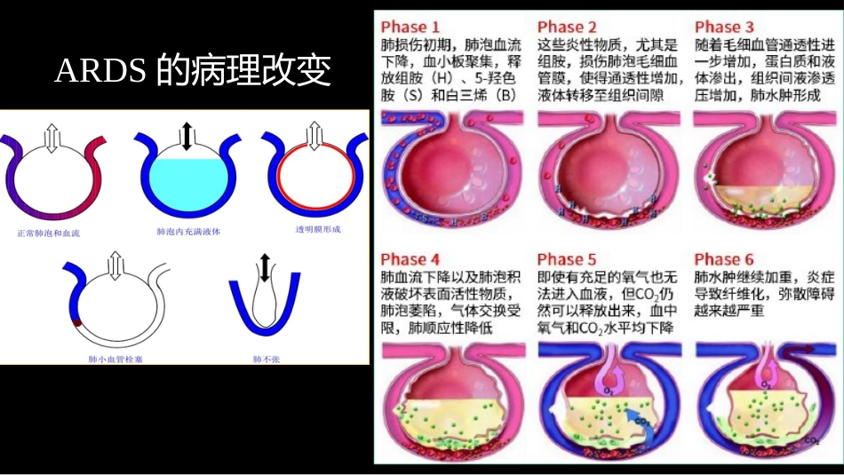 急性呼吸窘迫综合征(ARDS)的-影像学表现_第10页