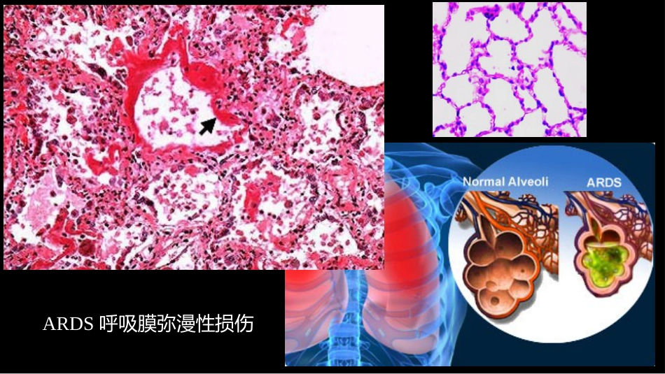 急性呼吸窘迫综合征(ARDS)的-影像学表现_第12页