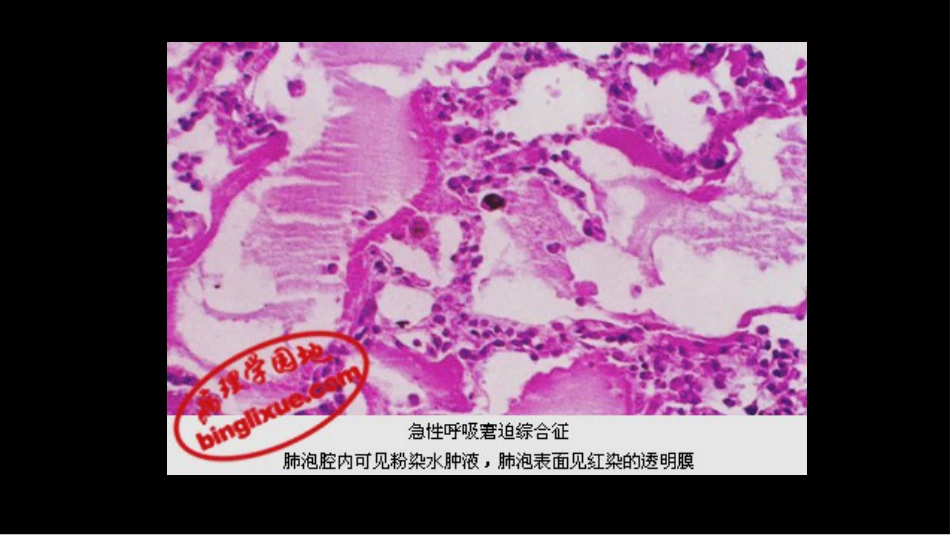 急性呼吸窘迫综合征(ARDS)的-影像学表现_第13页