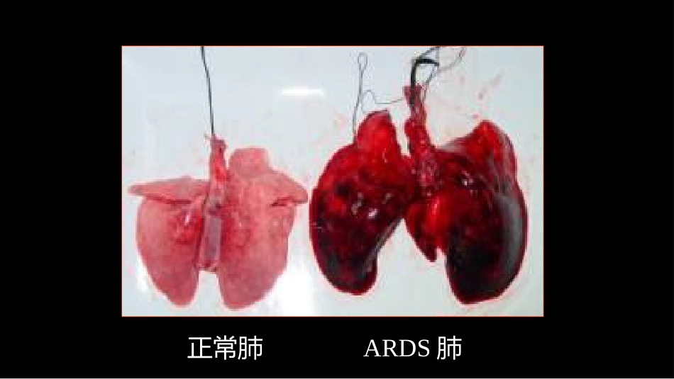 急性呼吸窘迫综合征(ARDS)的-影像学表现_第14页