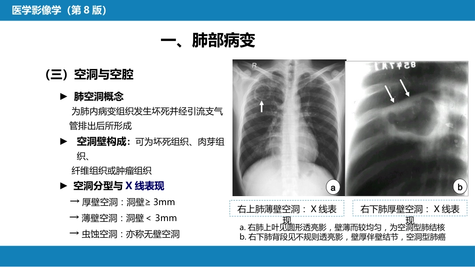第四章 呼吸系统 第三节 基本病变表现_第12页