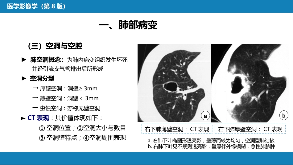 第四章 呼吸系统 第三节 基本病变表现_第13页