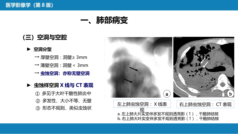 第四章 呼吸系统 第三节 基本病变表现_第14页