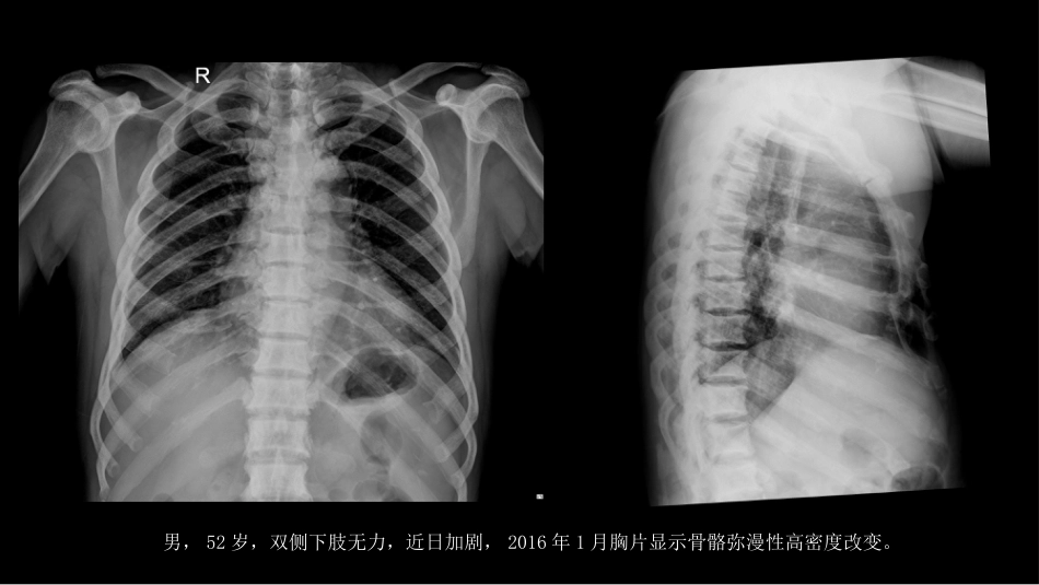 氟骨症的X线CT及MR影像及解读_第2页