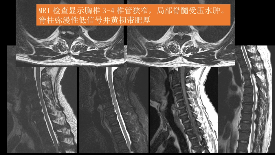 氟骨症的X线CT及MR影像及解读_第3页