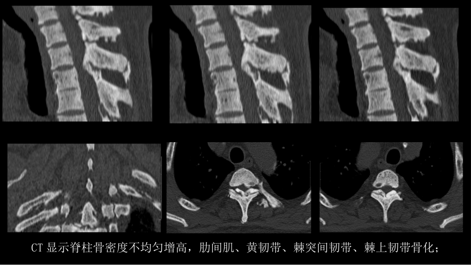 氟骨症的X线CT及MR影像及解读_第4页