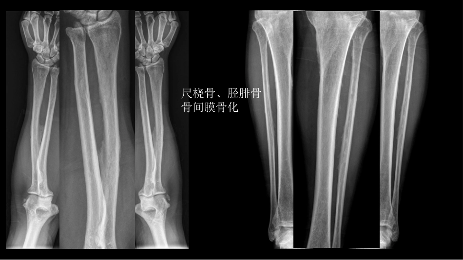 氟骨症的X线CT及MR影像及解读_第5页