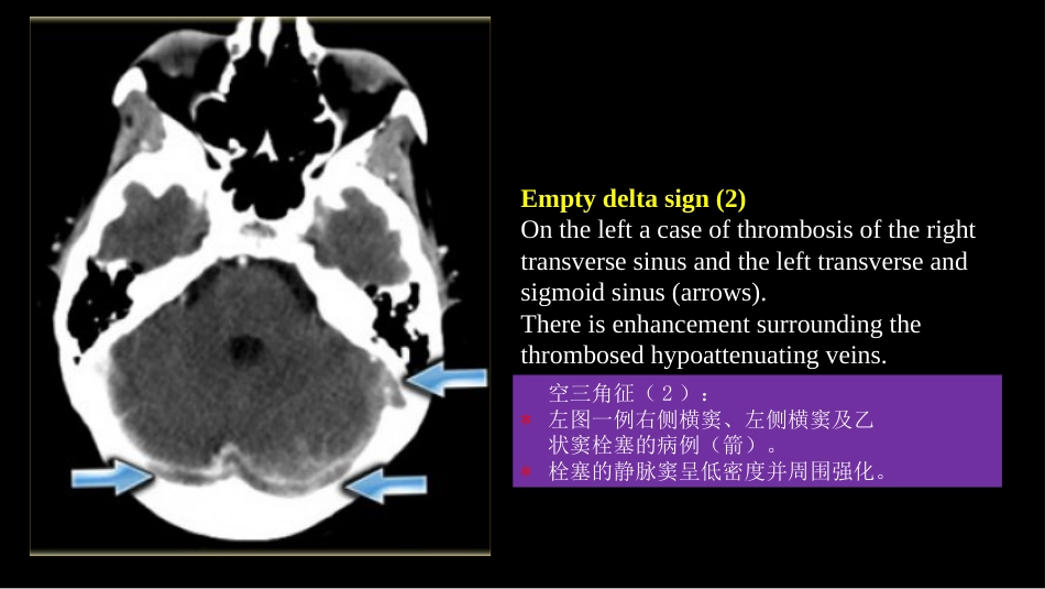 脑静脉血栓形成影像学_第10页