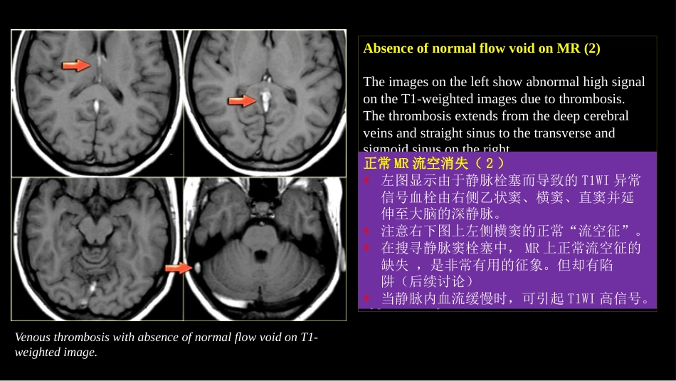 脑静脉血栓形成影像学_第12页