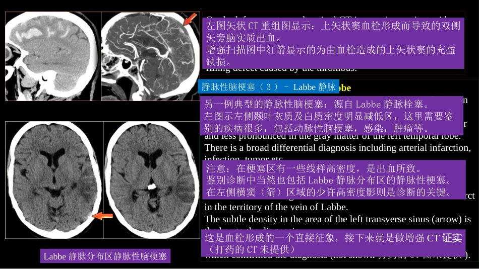 脑静脉血栓形成影像学_第15页
