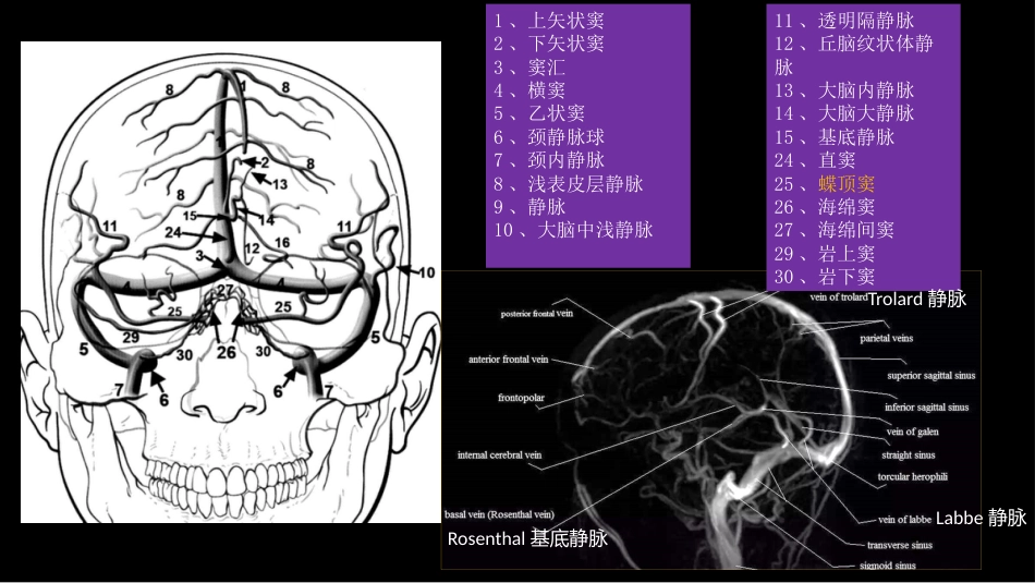 脑静脉血栓形成影像学_第5页