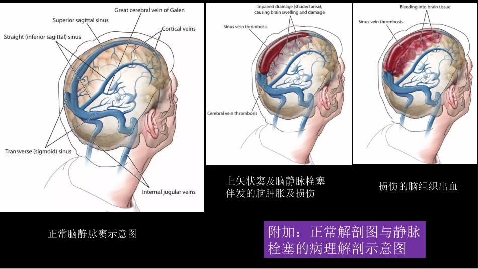脑静脉血栓形成影像学_第6页