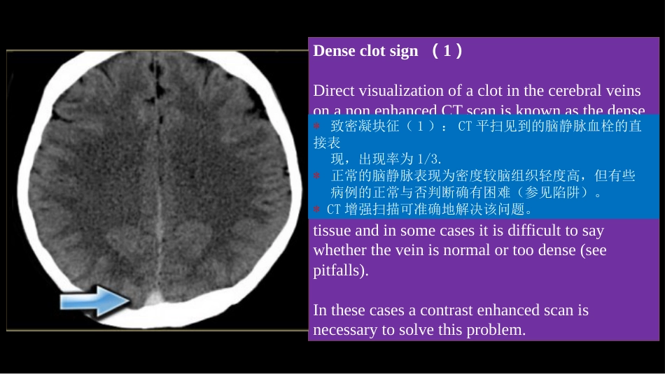 脑静脉血栓形成影像学_第7页