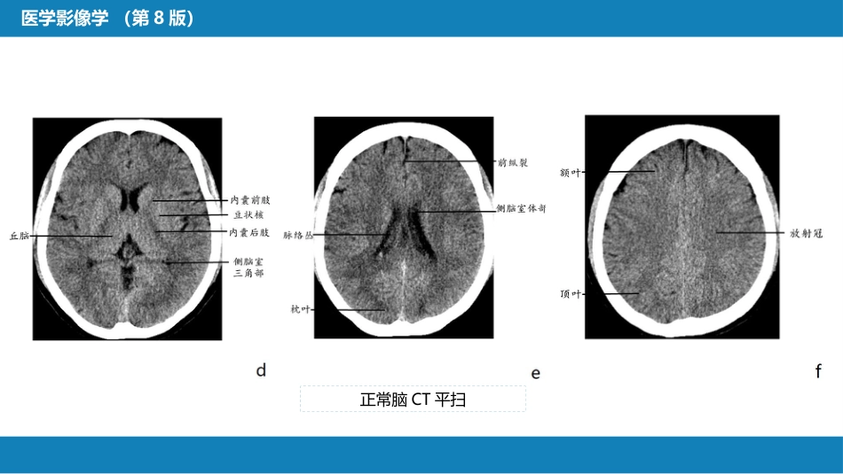 第二章 中枢神经系统 第二节 正常影像表现_第11页