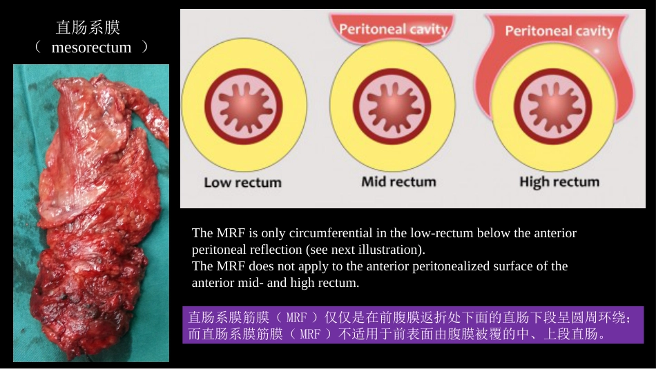 直肠癌：MRI与临床_第10页